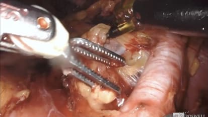 Master Class on Bladder Cancer: Robot-Assisted Radical Cystectomy with Pelvic Lymph Node Dissection and Intracorporeal Ileal Conduit