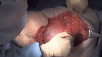 Ventral Hernia Repair Using the Components Separation Technique