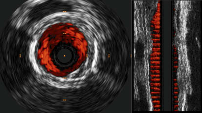 IVUS guided Phoenix atherectomy system case study: SFA treatment