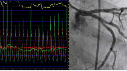 Techniques and Pitfalls and FFR and iFR Measurements with Dr. Amir Lerman