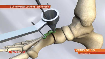 ORTHOLOC™ 3Di Foot Reconstruction System Lapidus Plate Animation [009115]