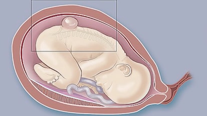 Spina bifida: Surgery plus stem cells before birth could improve outcomes (video)