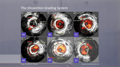 IVUS dissection PAD