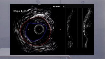 IVUS plaque burden 