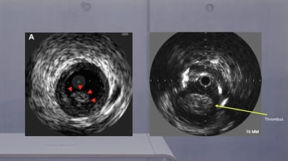 IVUS thrombus PAD