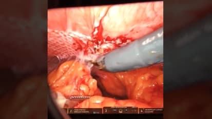 Post-Operative View: 18-Months Post-Implantation GORE® SYNECOR Intraperitoneal Biomaterial Hybrid Mesh
