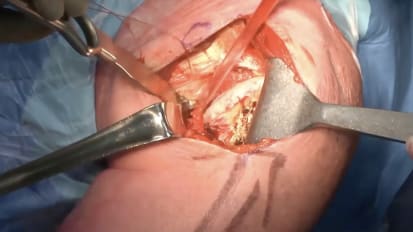 ASES Shoulder Arthroplasty: Exposure, Humerus and Glenoid 