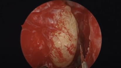 Endoscopic orbital decompression