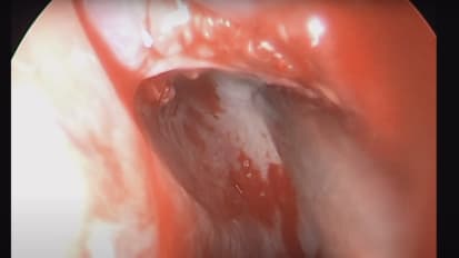 Endoscopic transsphenoidal approach for pituitary tumor resection