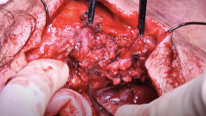 Superficial parotidectomy with facial nerve preservation