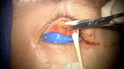 Mount Sinai Otolaryngology Surgical Series: Eyelid Weight Placement for Facial Paralysis
