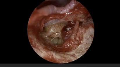 Mount Sinai Otolaryngology Surgical Series: Endoscopic Ear Surgery: Facial Nerve Hemangioma Removal