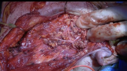 Mount Sinai Otolaryngology Surgical Series: Parotidectomy