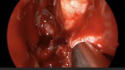 Mount Sinai Otolaryngology Surgical Series: Orbital Decompression for Graves Disease