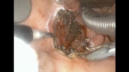 Mount Sinai Otolaryngology Surgical Series: TORS Robotic Resection of HPV-Related Tonsil and Throat Cancer