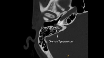 Mount Sinai Otolaryngology Surgical Series: Endoscopic Ear Surgery: Glomus Tympanicum (Tympanic Paraganglioma)