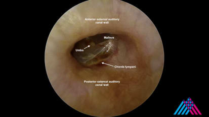 Mount Sinai Otolaryngology Surgical Series: Revision Stapedectomy for Otosclerosis
