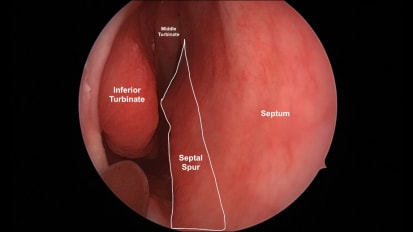 Mount Sinai Otolaryngology Surgical Series: Septoplasty, Turbinate Reduction Surgery