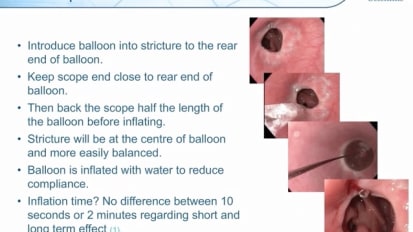 Treatment of Benign Strictures in the Esophagus, by Christer Staël von Holstein, MD