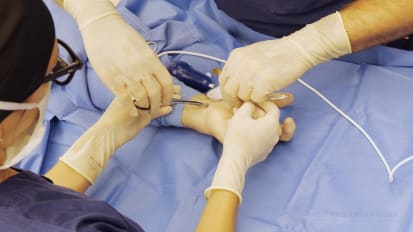 Treating Carpal Tunnel Syndrome Outside the OR Shortens Procedure and Recovery Times
