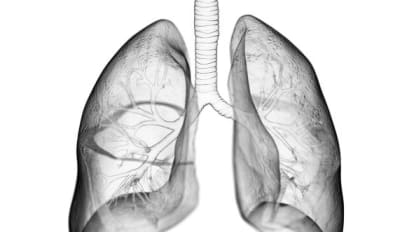 Pulmonary Hypertension and Lung Transplantation: Where Are We in 2023?