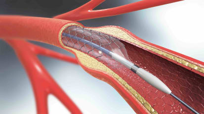 Carotid Endarterectomy and Stenting