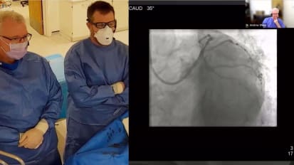 Case review of IVUS-guided PCI for a long, but relatively uncomplicated lesion