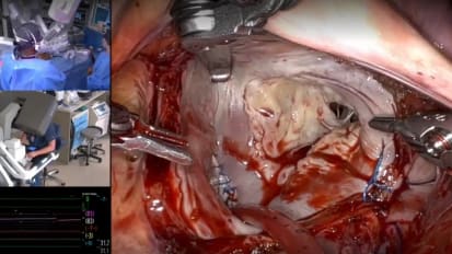 Live Case: Robotic Mitral Valve