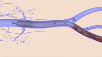 Venous Disease: Update on Management