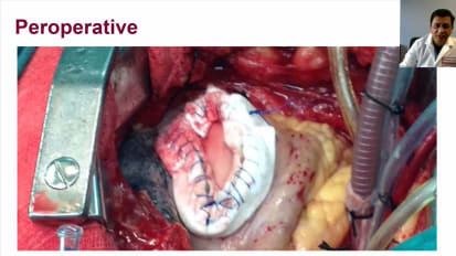 Successful Surgical Repair of Giant Left Ventricular Aneurysm With Porcelain Left Ventricle