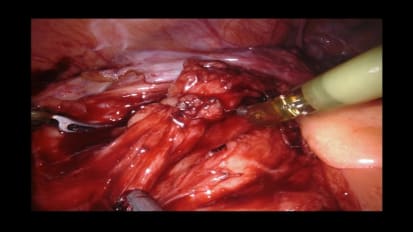 Robotic Assisted Laparoscopic Left Ileal Ureter Interposition for Long Segment Ureteral Stricture