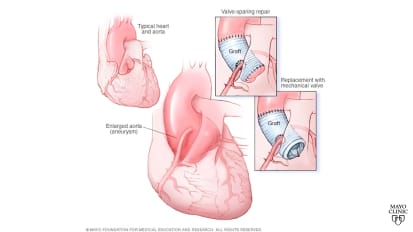 Thoracic aortic aneurysm and aortic root repair: Heart care at Mayo Clinic