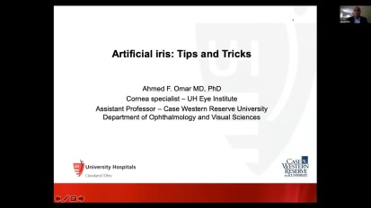 Artificial Iris: Tips and tricks 