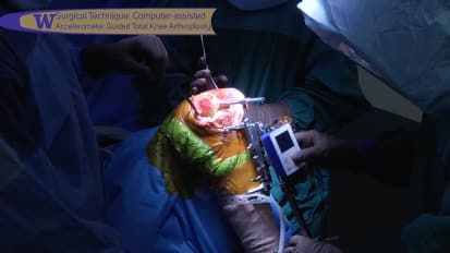 Computer Assisted Accelerometer Guided Total Knee Arthroplasty (Replacement) - A Surgical Technique 