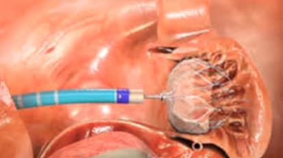 Catheter Based Treatment of Structural Heart Disease (SHD)