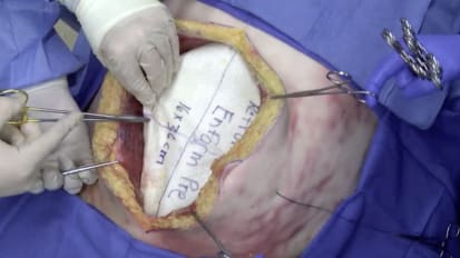 Retromuscular hernia repair using GORE<sup>®</sup> ENFORM Preperitoneal Biomaterial with percutaneous suture fixation