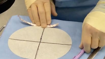 Robotic Sugarbaker Repair of a Parastomal Hernia utilizing GORE® SYNECOR Intraperitoneal Biomaterial