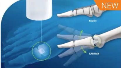 Surgical Treatment of Hallux Rigidus: Arthroplasty featuring CARTIVA® [AP-014122]