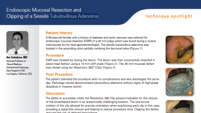 EMR and Clipping of a Sessile Tubulovillous Adenoma Presented by Ara Sahakian, MD