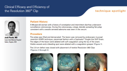 Clinical Efficacy and Efficiency of the Resolution 360™ Clip Presented by John Pineda, MD