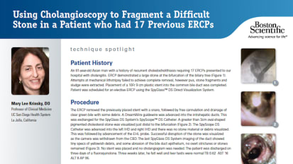 Using Cholangioscopy to Fragment a Difficult Stone in a Patient who had 17 Previous ERCPs by Mary Lee Krinsy, D.O.