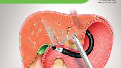 Acquire™ 19ga Flexible FNB Device: Suitable for EUS-Guided Liver Biopsy