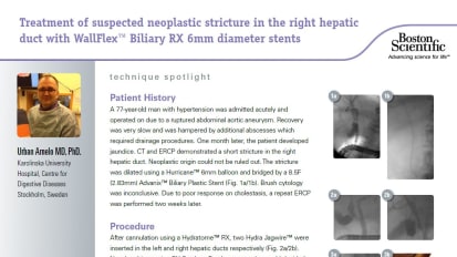 Treatment of Suspected Neoplastic Stricture in the Right Hepatic Duct with a 6mm Metal Stent, presented by Urban Arnelo MD, PhD.