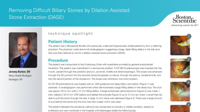 Removing Difficult Biliary Stones Using DASE, Jeremy Barber, DO