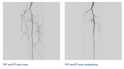 Turbo-Elite case study tibial CTO Amin