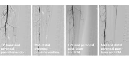 Shah Turbo-Elite case review - recanalization of the right peroneal artery via 4F sheath