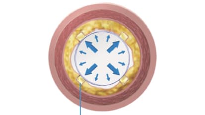 AngioSculpt PTA Scoring Balloon Catheter 7 and 8 mm Diameters: Power to Score