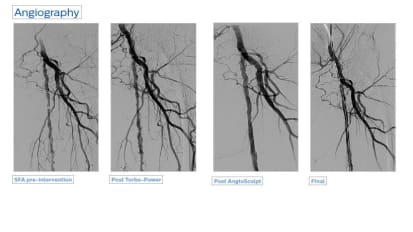 Turbo-Power AngioSculpt peripheral case study