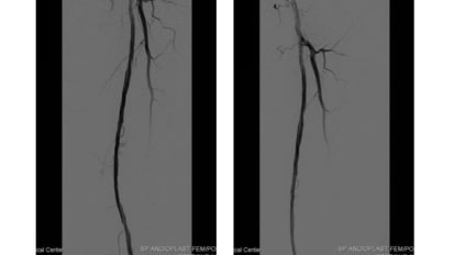 Cedrone - Turbo-Power DCB case study