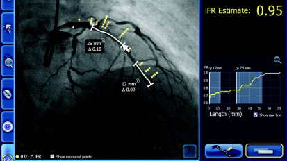 DEFINE PCI Unseen focal lesions cause residual ischemia